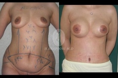 Abdominoplasty
