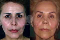 Face Lift