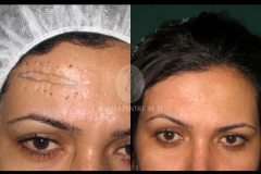 Scar Reconstruction
